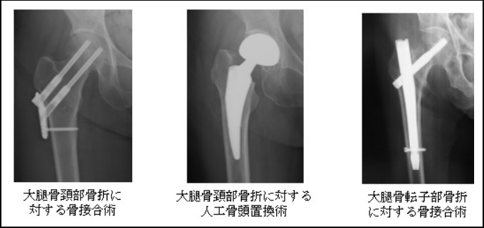 大腿骨骨折の手術方法の画像